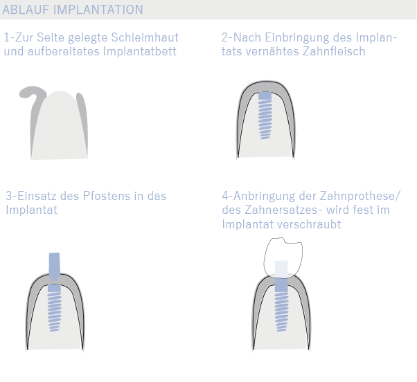 Zahnimplantate - Ablauf einer Implantation - Klinik am Kurfürstendamm
