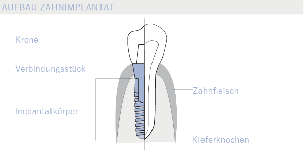 Zahnimplantat Aufbau