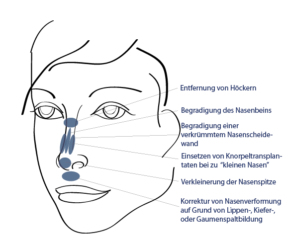 Nasenkorrektur Berlin Ablauf Kosten Finanzierung